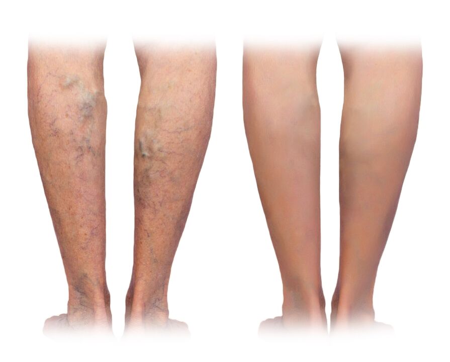 Legs with varicose veins before and after using Veniselle cream