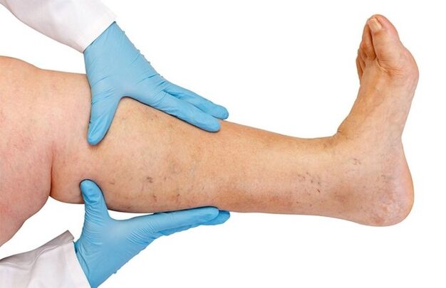 Varicose veins on the legs